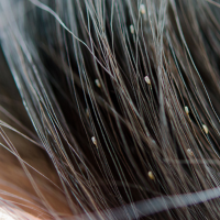 A stock image of woman with lice